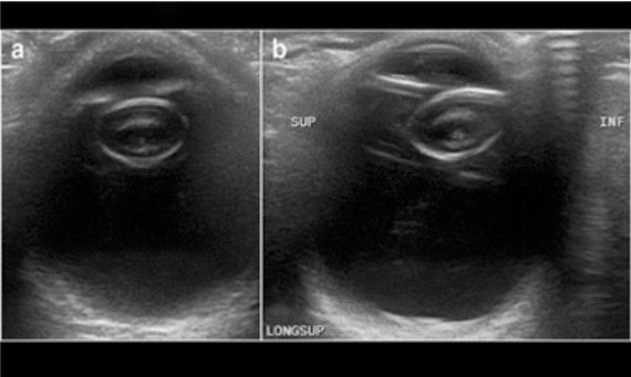 Upper Abdomen
