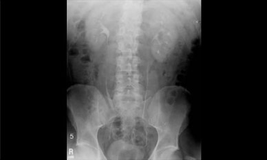Whole Abdomen