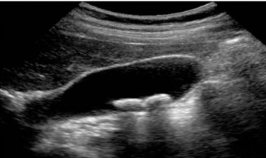 Upper Abdomen